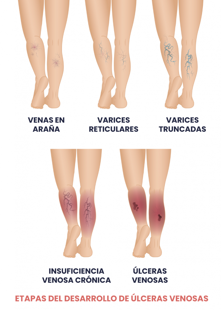 🦵🏻Úlceras venosas en miembros inferiores - Innovacure