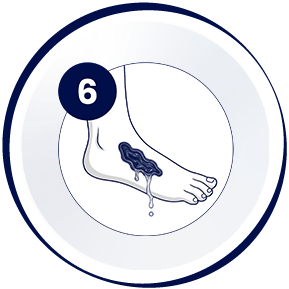 Técnica de irrigación de Vashe - Paso 06